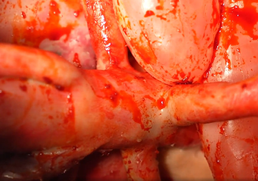 胸腹部損傷控制手術(shù)模擬人系統(tǒng)3.0